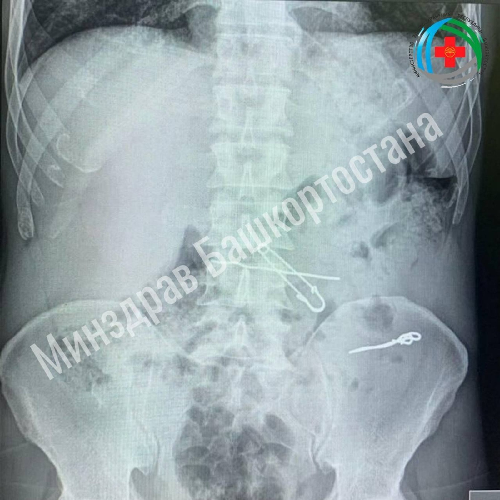 Уфимец проглотил ключи, скрепки, булавку и проволоку