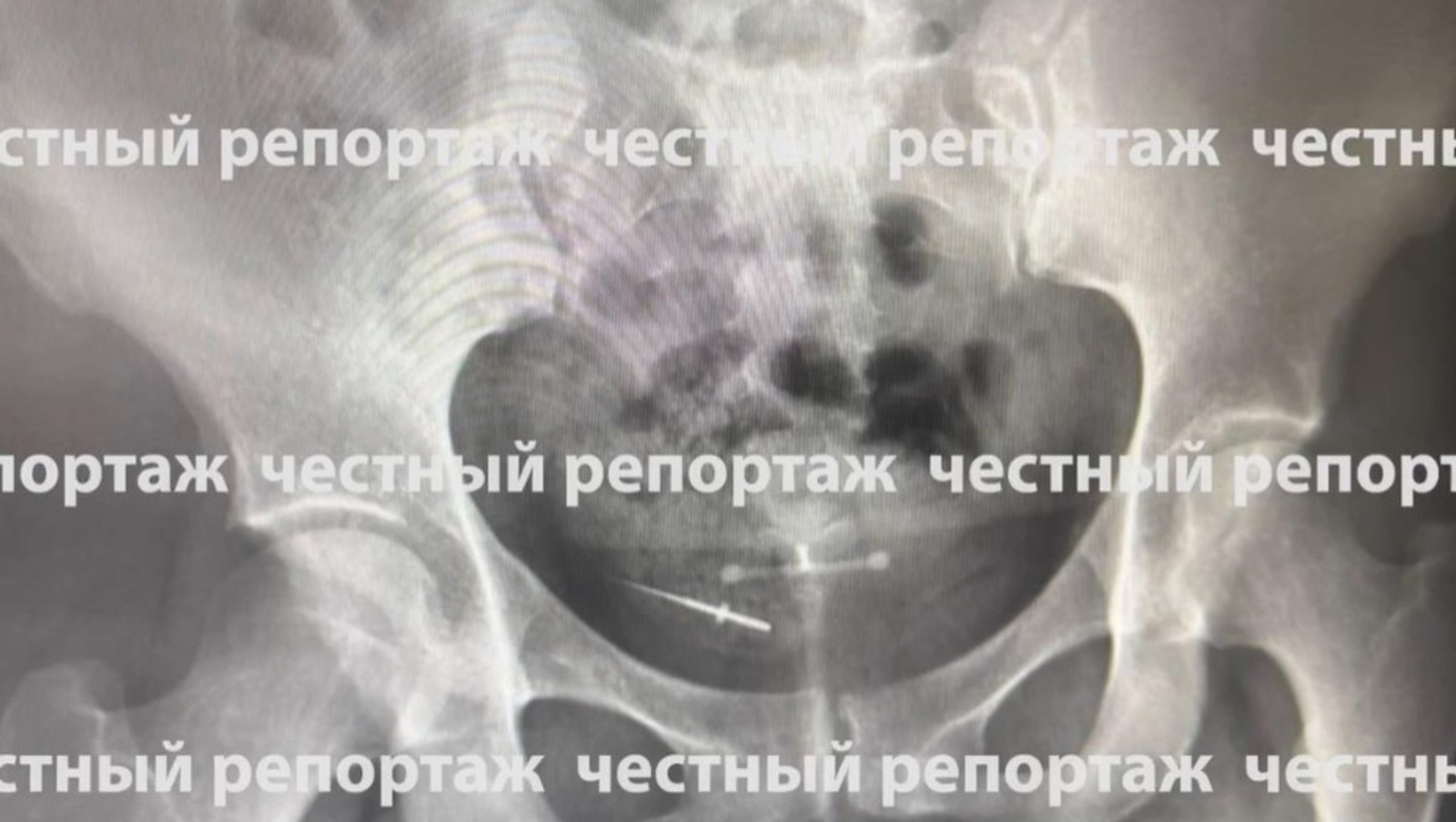 В Башкирии в кишечнике женщины обнаружили иголку